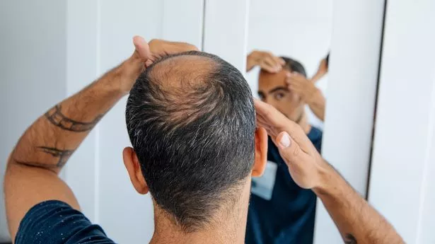 alopecija