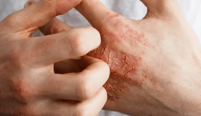 atopijski dermatitis