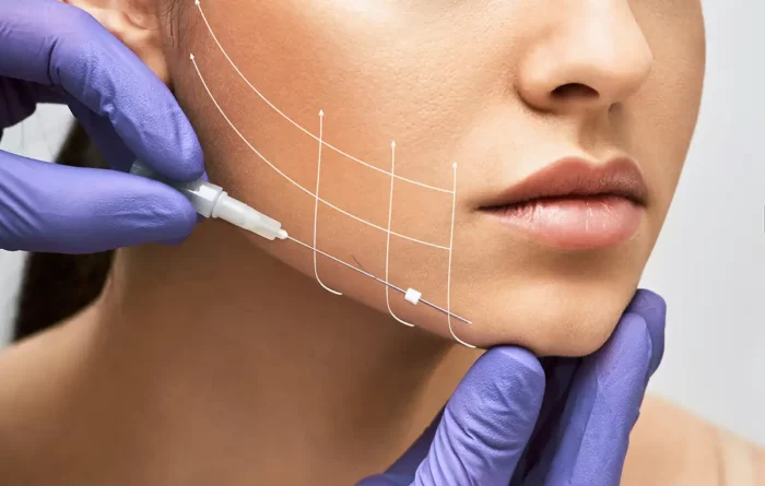 facelif face lifting