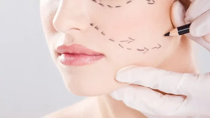 facelift face lifting