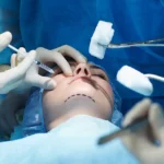 glumičić estetska kirurgija rinoplastika