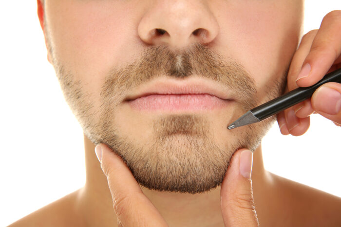 mentoplastika korekcija brade