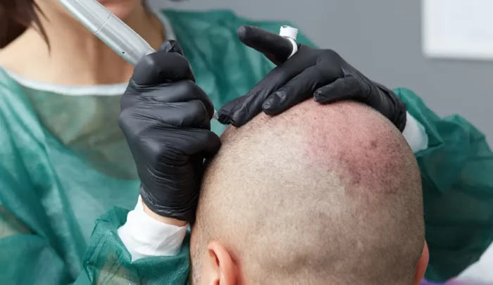 presađivanje kose transplantacija kose