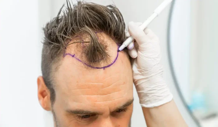 presađivanje kose transplantacija kose oporavak