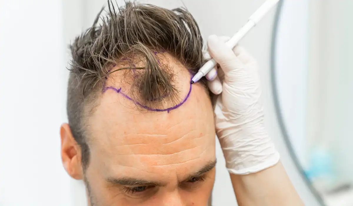 presađivanje kose transplantacija kose oporavak