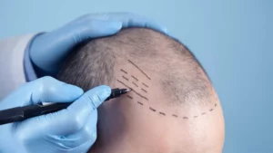 transplantacija kose presađivanje kose