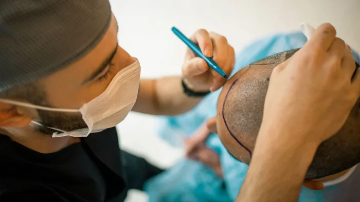 hair transplant Turkey Istanbul transplantacija kose presađivanje kose