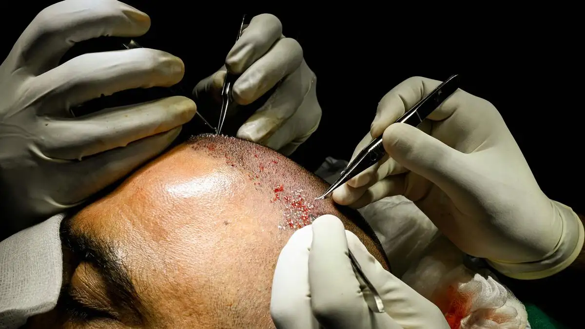 Neograft: Automatizirana FUE tehnika za transplantaciju kose