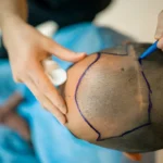 transplantacija kose turska istanbul
