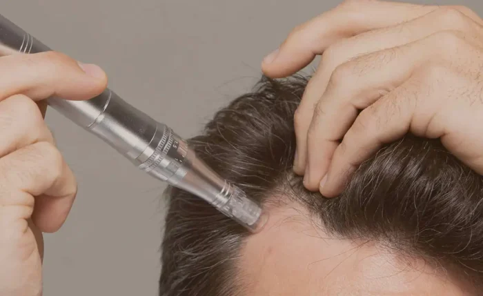 microneedling for hair loss