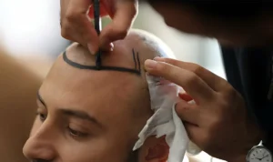 Transplantacija kose: Moje osobno iskustvo presađivanja kose u Turskoj
