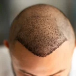 transplantacija kose turska presađivanje kos