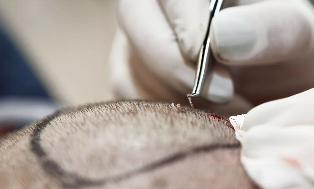 DHI transplantacija kose u Sarajevu: kad sam shvatio da me frizer žali, a ne šiša