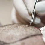 Hair Transplant Istanbul Hair transplant Turkey