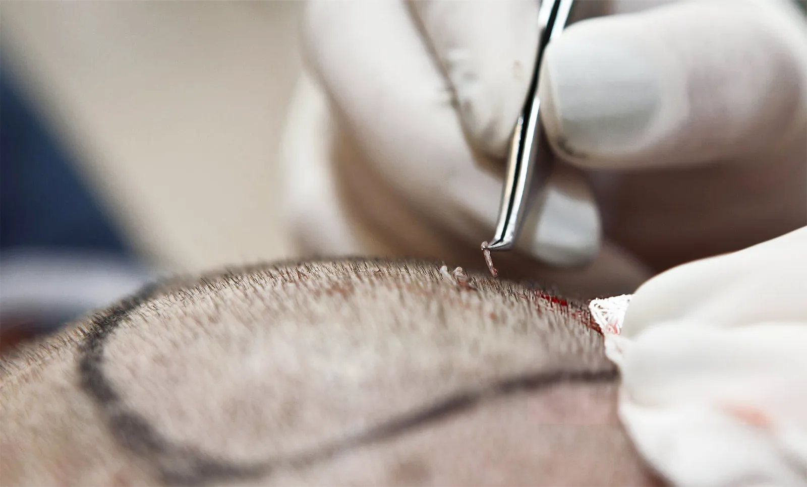 DHI transplantacija kose u Sarajevu: kad sam shvatio da me frizer žali, a ne šiša