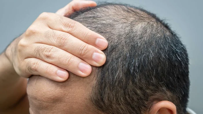 Hair Transplant Istanbul risks side effects complications