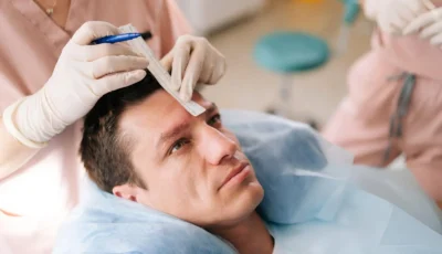 Unraveling Istanbul Hair Transplant Packages: The Root of the Solution