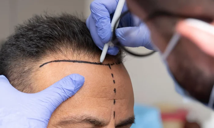 Safe Hair Transplants in Turkey