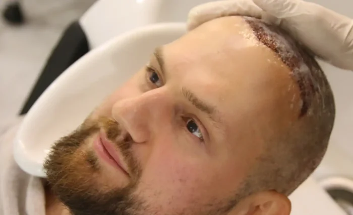 What to expect 1 week after a hair transplant