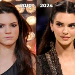 Kendall Jenner plastic surgery