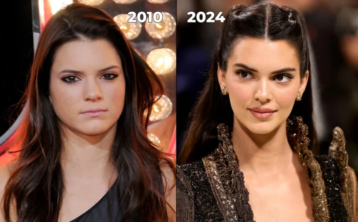 Kendall Jenner plastic surgery