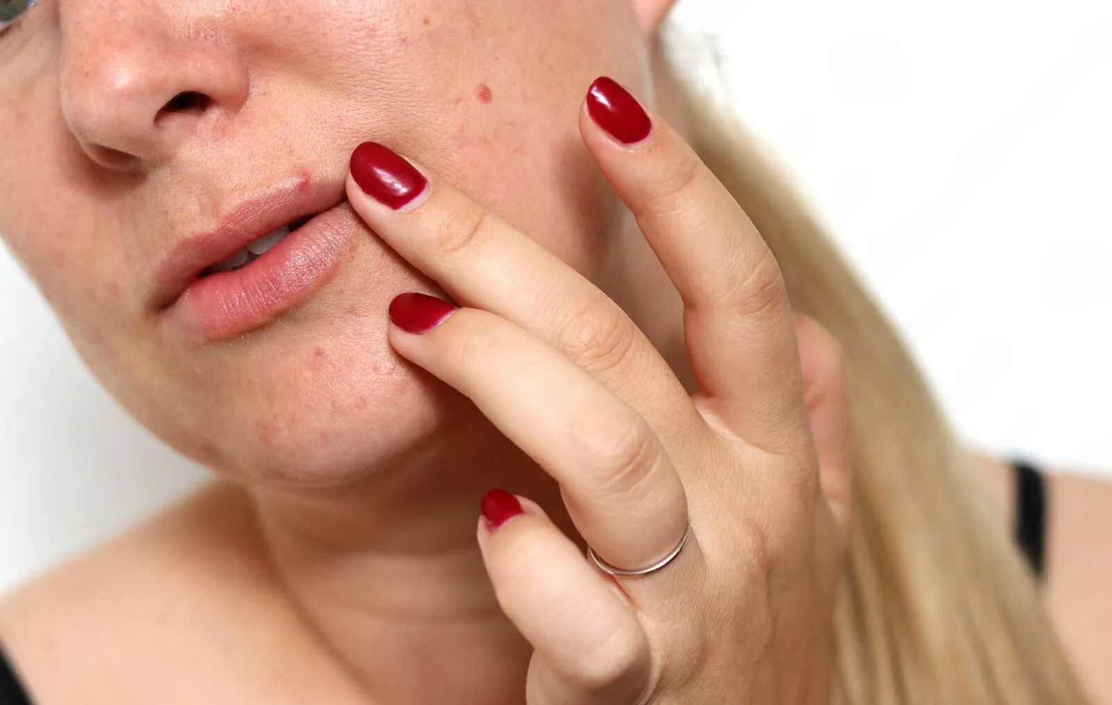 We Fought the Blemishes, You Reap the Benefits: 5 Best Moisturizers for Acne in 2025